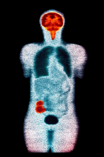 Image: Colored frontal PET scan of a patient with colon cancer (photo courtesy Sovereign, ISM).